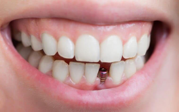 Dental Implants in turkey